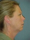 Facelift, necklift, browlift, upper and lower blepharoplasty 470258