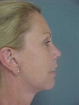Facelift, necklift, browlift, upper and lower blepharoplasty 470258