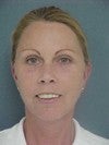 Facelift, necklift, browlift, upper and lower blepharoplasty after 470258