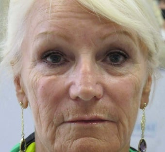 Wrinkle treatment for woman for lower face before 851422