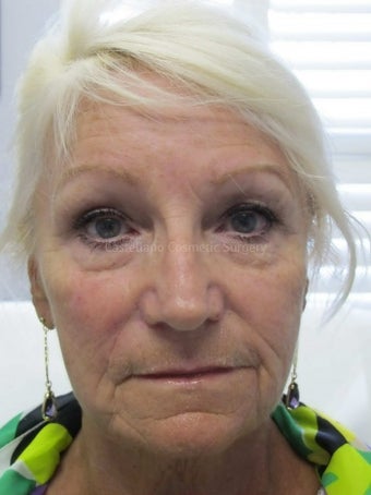 Wrinkle treatment for woman for lower face after 851422