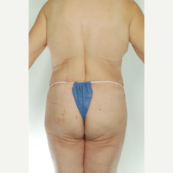 52 year old woman treated with Body Lift 1661511