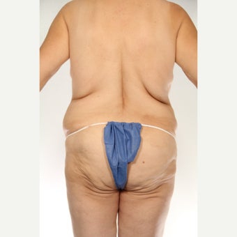 52 year old woman treated with Body Lift 1661511