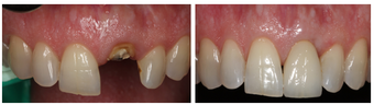 Single Tooth Dental Implant before 1008330