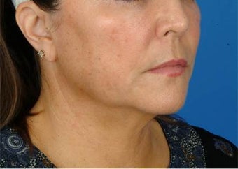 53 year old female treated with Ultherapy for jawline and neck before 1190872
