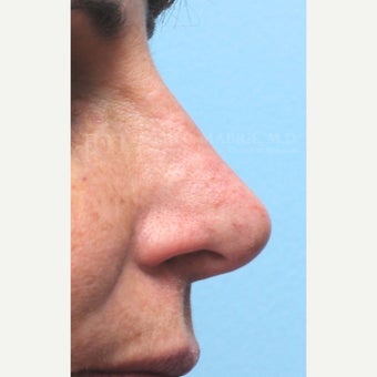 Woman treated with Non-Surgical Revision Rhinoplasty after 1843229