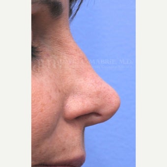 Woman treated with Non-Surgical Revision Rhinoplasty before 1843229