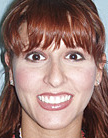Rhinoplasty before 890320