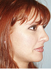 Rhinoplasty 890320