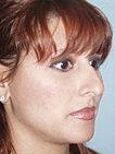 Rhinoplasty 890320
