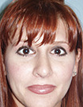 Rhinoplasty after 890320