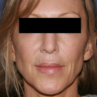 54 year old woman treated with Lip Lift after 3710922
