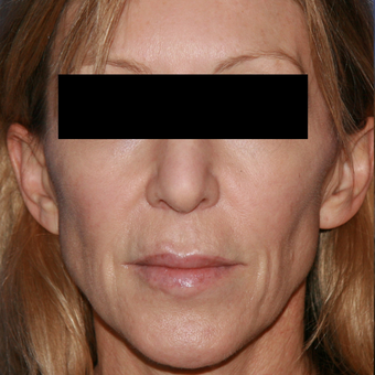54 year old woman treated with Lip Lift before 3710922