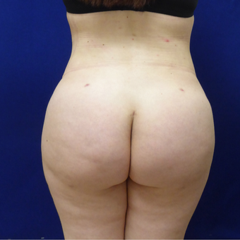 27 y/o female - 1500cc per side Lipo abdomen, flanks, back with fat transfer to the buttocks after 3433750