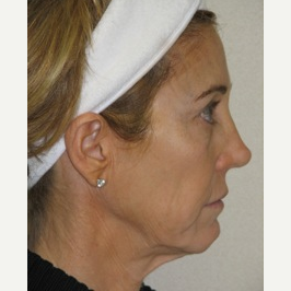 45-54 year old woman treated with Ultherapy and Fillers before 3141693