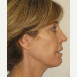 45-54 year old woman treated with Ultherapy and Fillers after 3141693