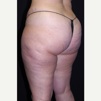 45-54 year old woman treated with Cellulaze before 3280726