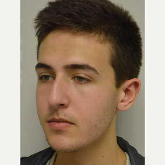 17 year old man treated with Nose Surgery before 3123007