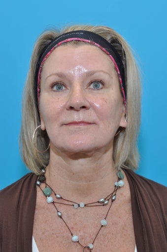 60-year-old female for 1st Botox Treatment after 924507