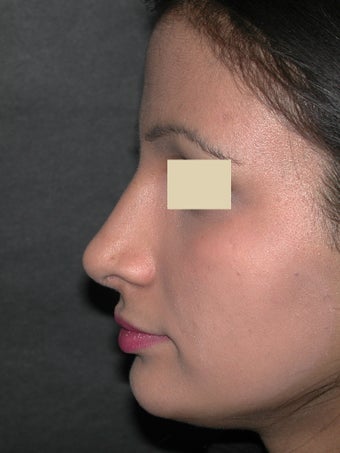 Rhinoplasty after 95658
