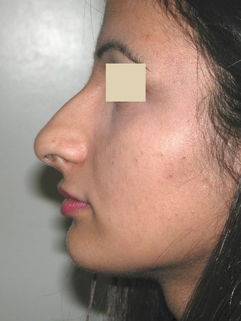 Rhinoplasty before 95658