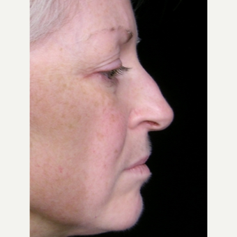49 year old woman treated with Rhinoplasty before 3839756