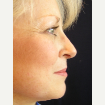 49 year old woman treated with Rhinoplasty after 3839756