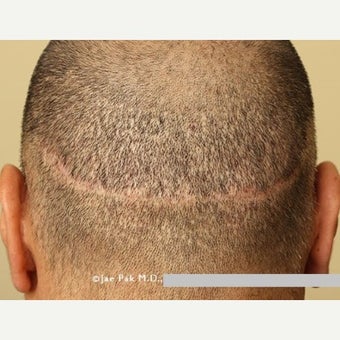 45-54 year old man treated with Scalp Micropigmentation plus Hair Transplant FUE before 2006931