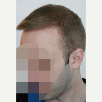 25-34 year old man treated with FUE Hair Transplant after 3656602