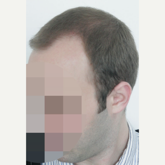 25-34 year old man treated with FUE Hair Transplant before 3656602
