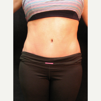 Abdominoplasty after 3719930