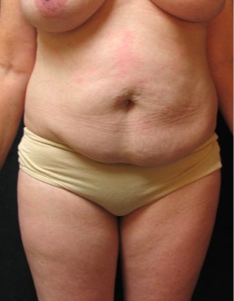 Abdominoplasty before 3719930