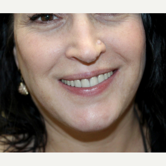 35-44 year old woman treated with Dental Crowns for Full Mouth Reconstruction after 3424195