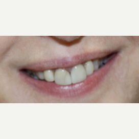 35-44 year old woman treated with Dental Crowns for Full Mouth Reconstruction before 3424195
