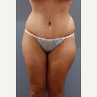 35-44 year old woman treated with Tummy Tuck after 3584070