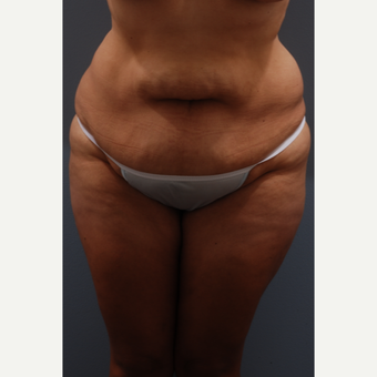 35-44 year old woman treated with Tummy Tuck before 3584070