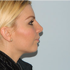 35-44 year old woman treated with Rhinoplasty after 3459322