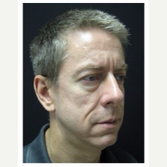 45-54 year old man treated with Non Surgical Face Lift before 3180996