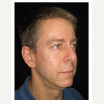 45-54 year old man treated with Non Surgical Face Lift after 3180996