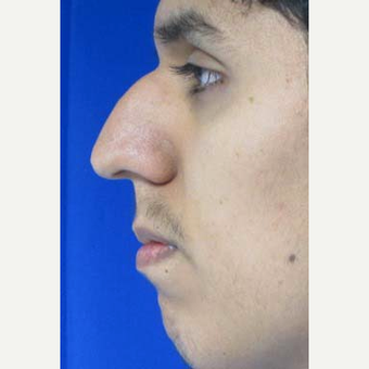 Rhinoplasty before 2993749