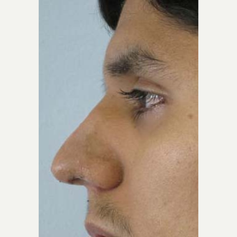 Rhinoplasty after 2993749