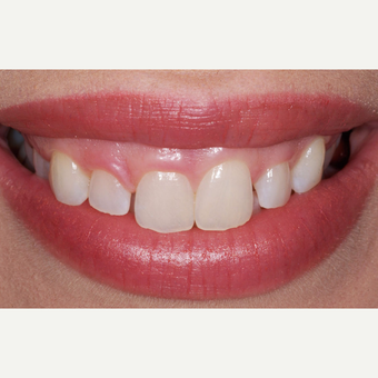 35-44 year old woman treated with Gum Lift before 3629707