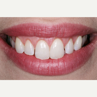 35-44 year old woman treated with Gum Lift after 3629707