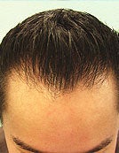 FUE – SFET Using Only Head Hair after 195671