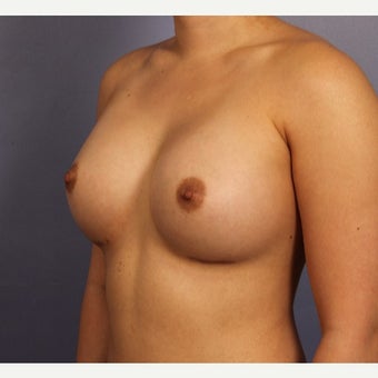 Late 20s female with Sientra Breast Implants after 1843095