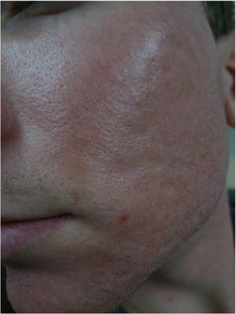 acne scars treated with Juvederm Volbella after 1423067