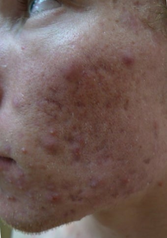 acne scars treated with Juvederm Volbella before 1423067