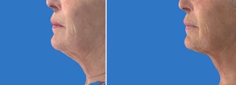 Ultherapy before 1214289