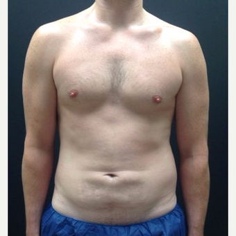 35-44 year old man treated with Liposuction before 3768870