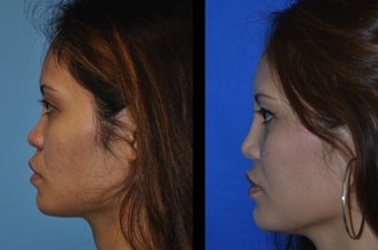 Asian Rhinoplasty after 1239646
